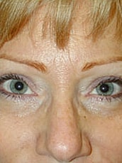 Facelift Before & After