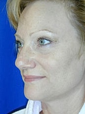 Facelift Before & After
