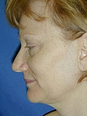 Facelift Before & After