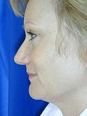 Facelift Before & After