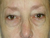Facelift Before & After