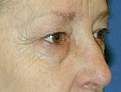 Facelift Before & After