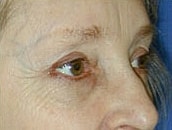 Facelift Before & After