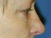 Facelift Before & After