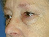 Facelift Before & After