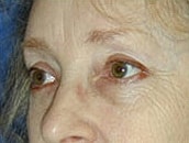 Facelift Before & After