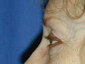 Facelift Before & After
