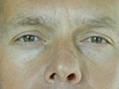 Facelift Before & After