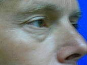 Facelift Before & After