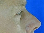 Facelift Before & After