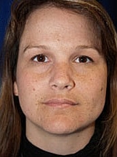 Facelift Before & After
