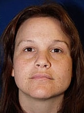 Facelift Before & After
