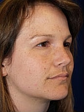 Facelift Before & After