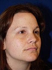 Facelift Before & After