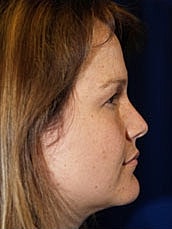 Facelift Before & After