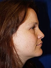 Facelift Before & After