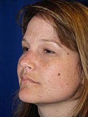 Facelift Before & After
