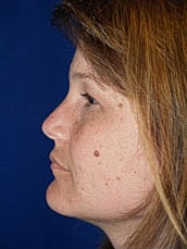 Facelift Before & After
