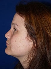 Facelift Before & After