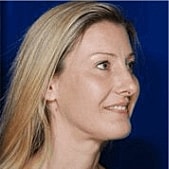 Facelift Before & After