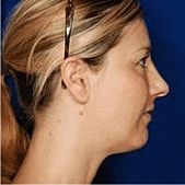 Facelift Before & After