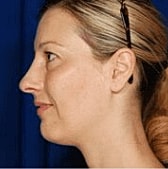 Facelift Before & After