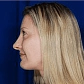 Facelift Before & After