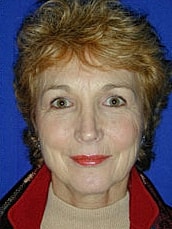 Facelift Before & After