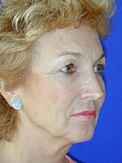 Facelift Before & After