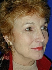 Facelift Before & After