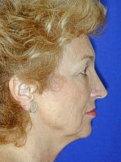 Facelift Before & After