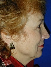 Facelift Before & After