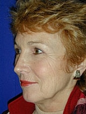 Facelift Before & After