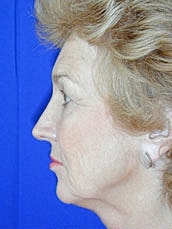 Facelift Before & After