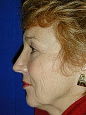Facelift Before & After