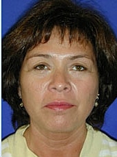 Facelift Before & After