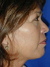 Facelift Before & After