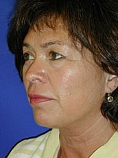 Facelift Before & After
