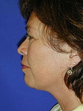 Facelift Before & After