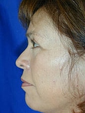 Facelift Before & After
