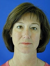 Facelift Before & After