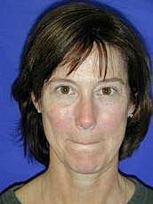 Facelift Before & After
