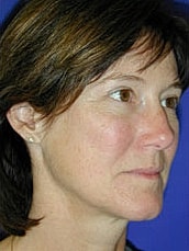 Facelift Before & After