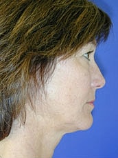 Facelift Before & After