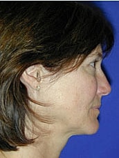 Facelift Before & After