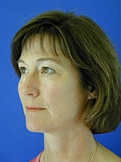 Facelift Before & After