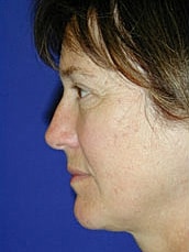 Facelift Before & After
