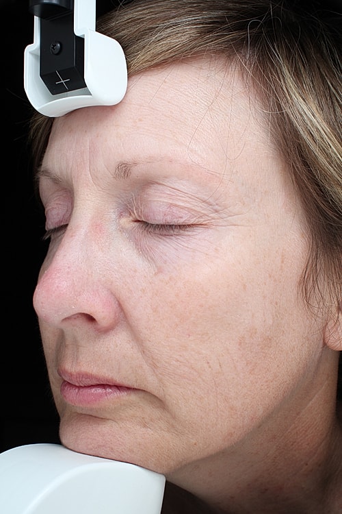 Facelift Before & After