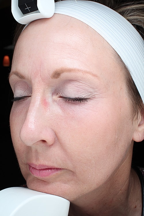 Facelift Before & After