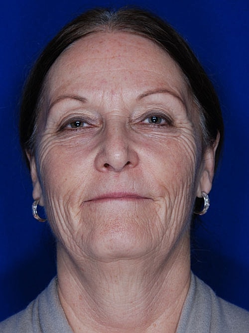 Facelift Before & After